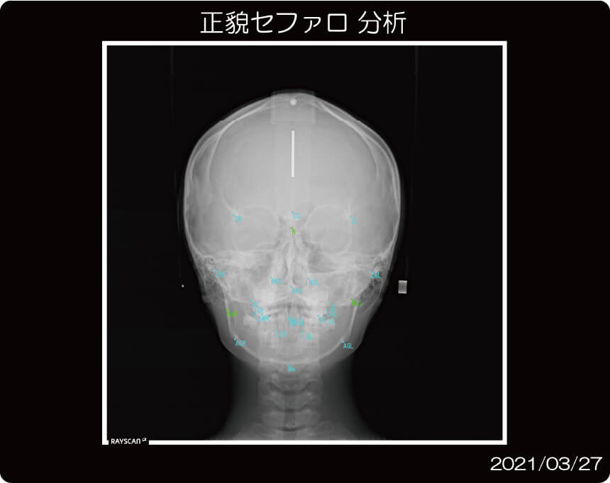 レントゲン写真(正貌セファロ)イメージ