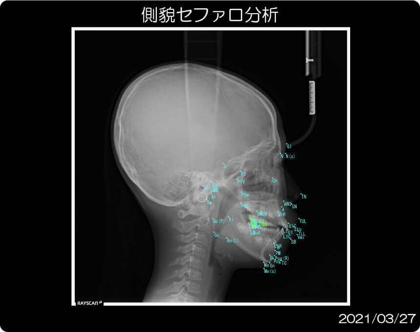 レントゲン写真(側貌セファロ)イメージ