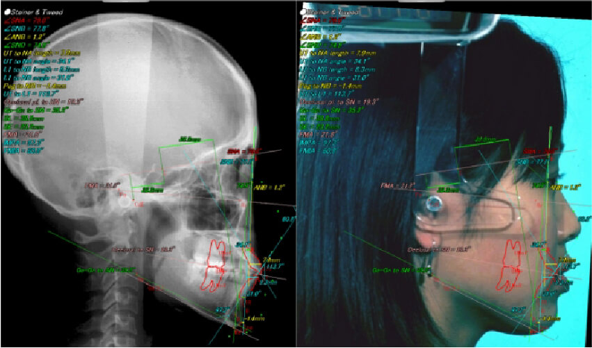 義歯成型器イメージ