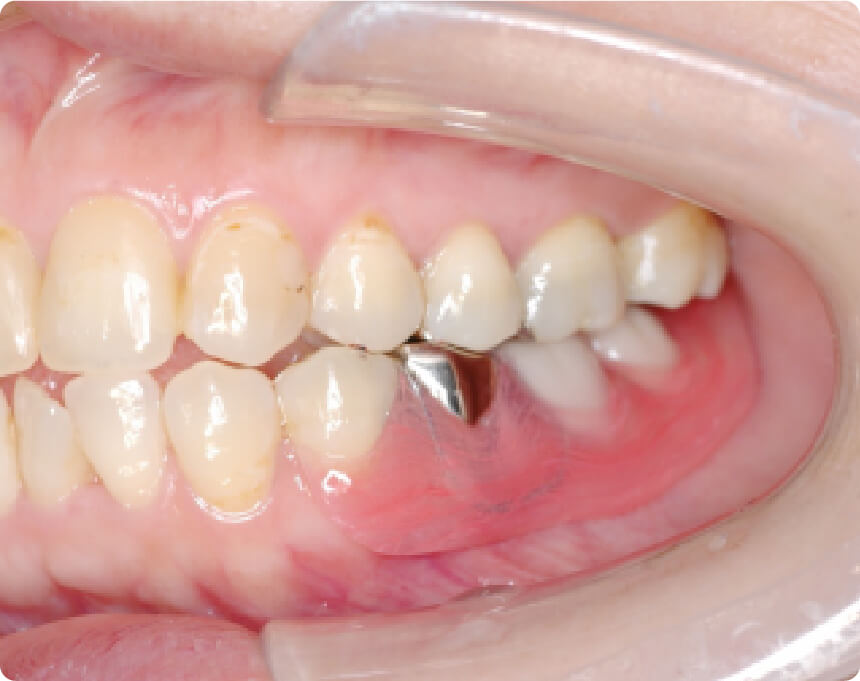 デンチャーイメージ